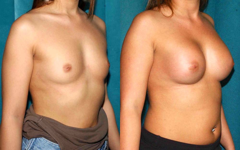 Breast implants and correction of inverted nipples
