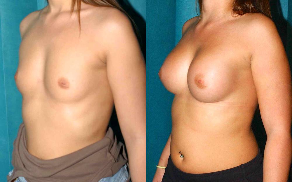 Breast implants and correction of inverted nipples