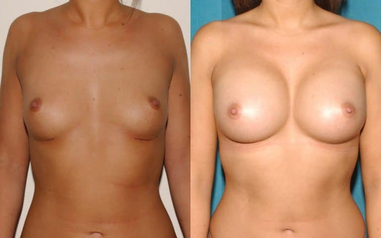Breast augmentation before and after, case 42, photo 1 of 4