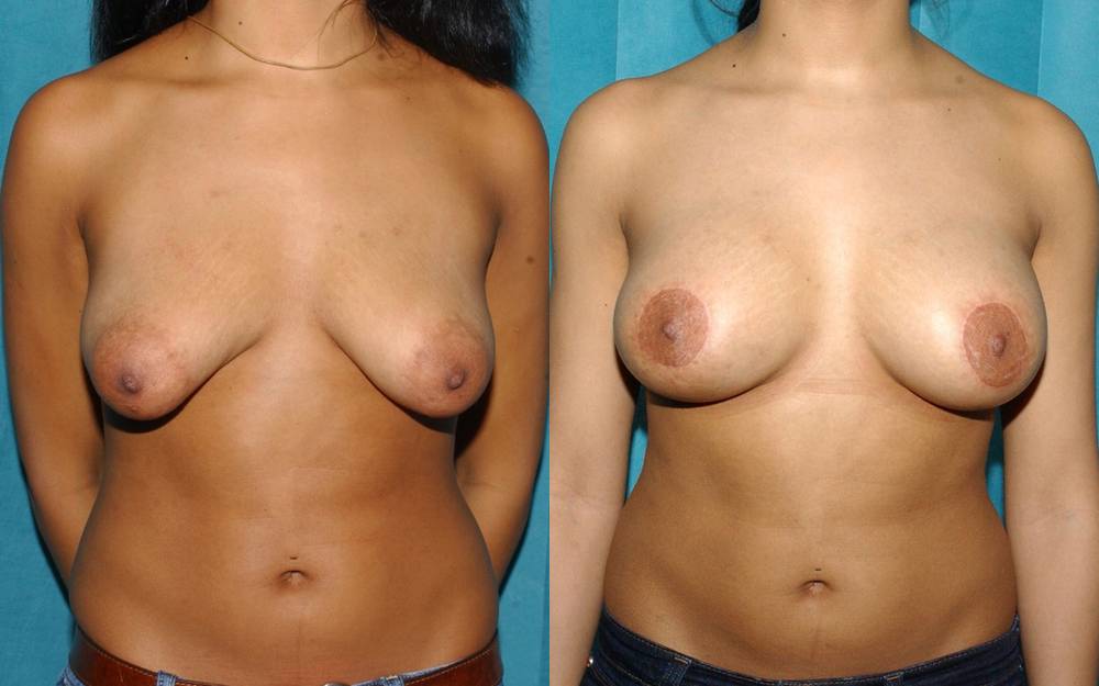 cosmetic breast surgery scotland
