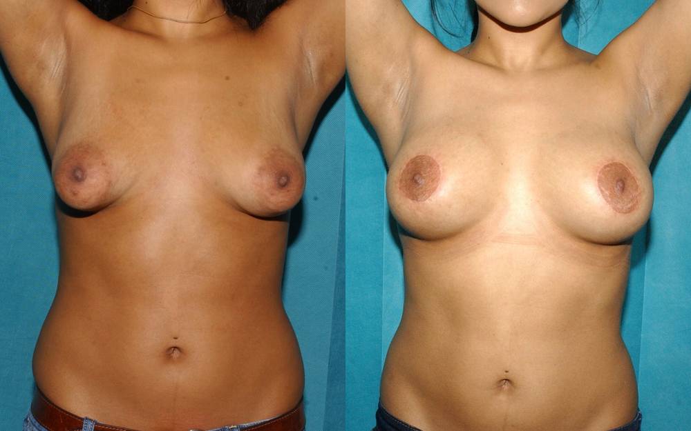 Correction of tubular breast deformity