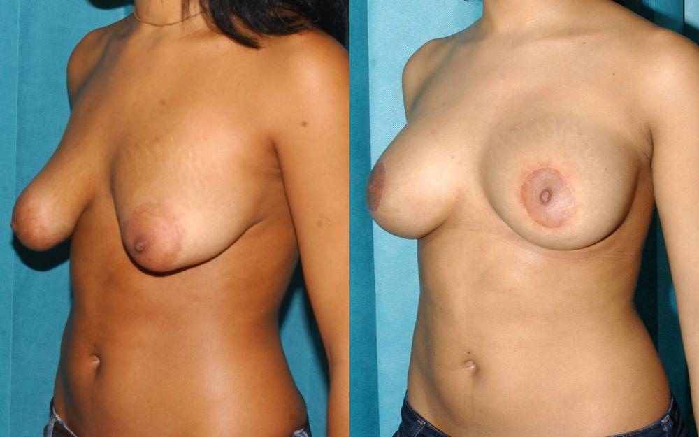 Correction of tubular breast deformity