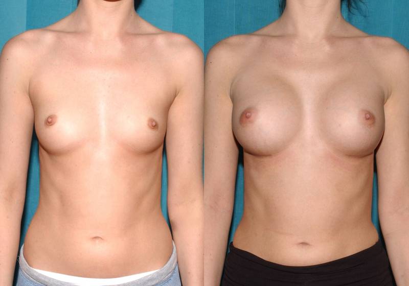 A to D cup breast enlargement