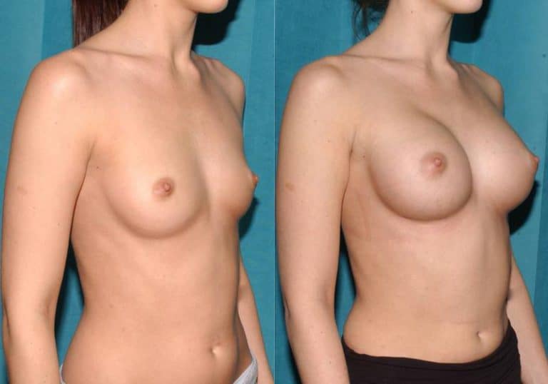 Breast augmentation before and after, case 39, photo 1 of 3