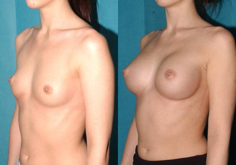 A to D cup breast enlargement