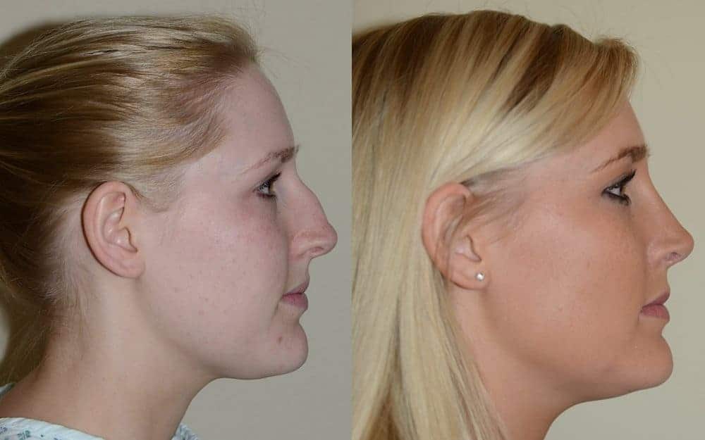 Open rhinoplasty with hump reduction and tip refinement