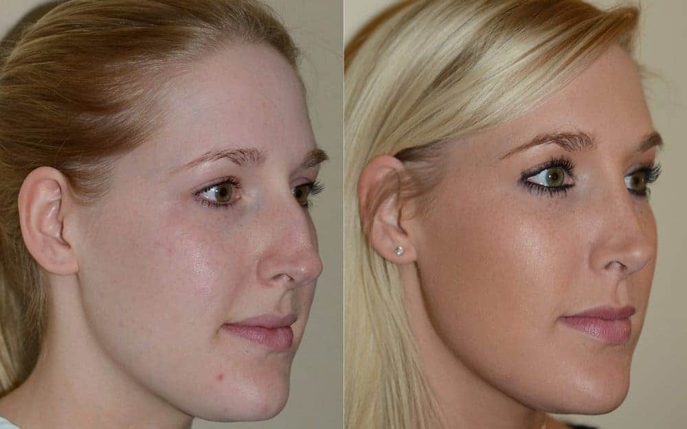 Open rhinoplasty with hump reduction and tip refinement