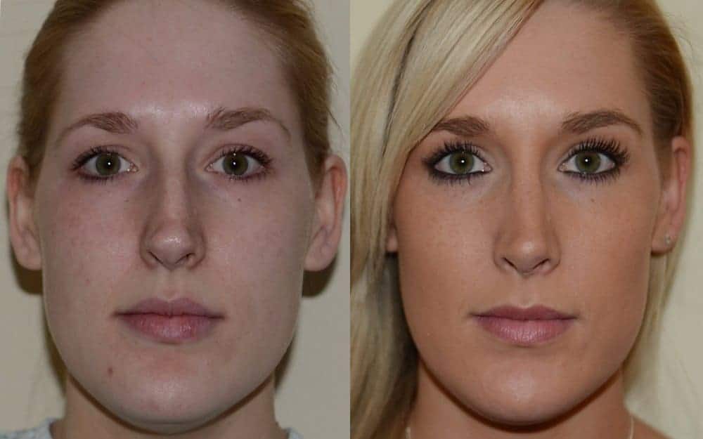 Open rhinoplasty with hump reduction and tip refinement