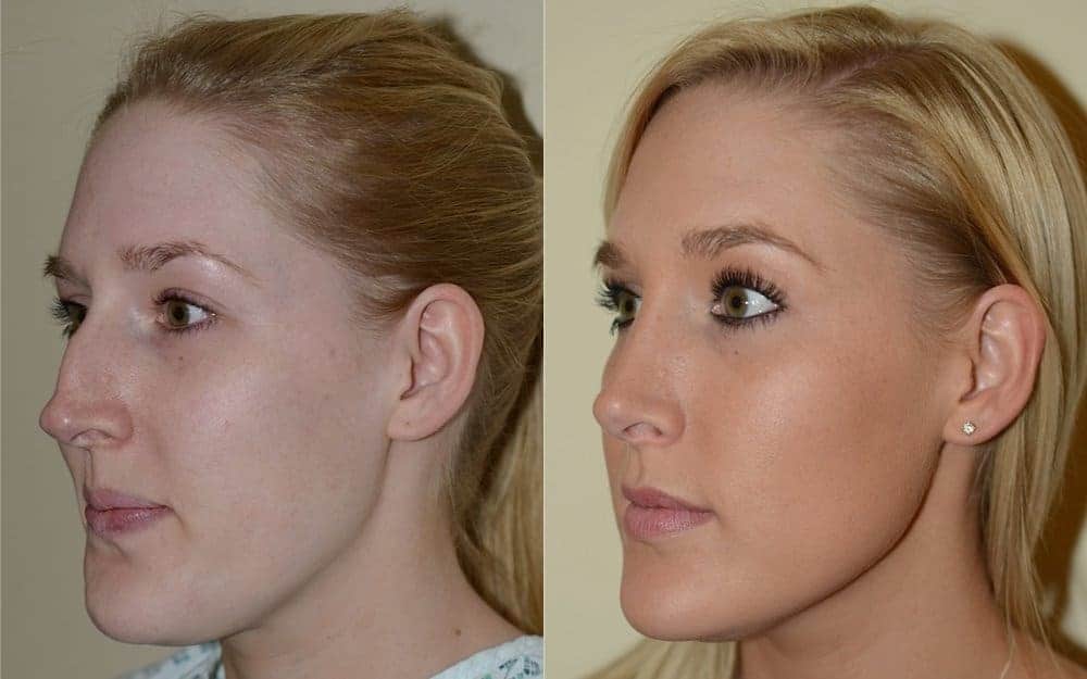 Open rhinoplasty with hump reduction and tip refinement