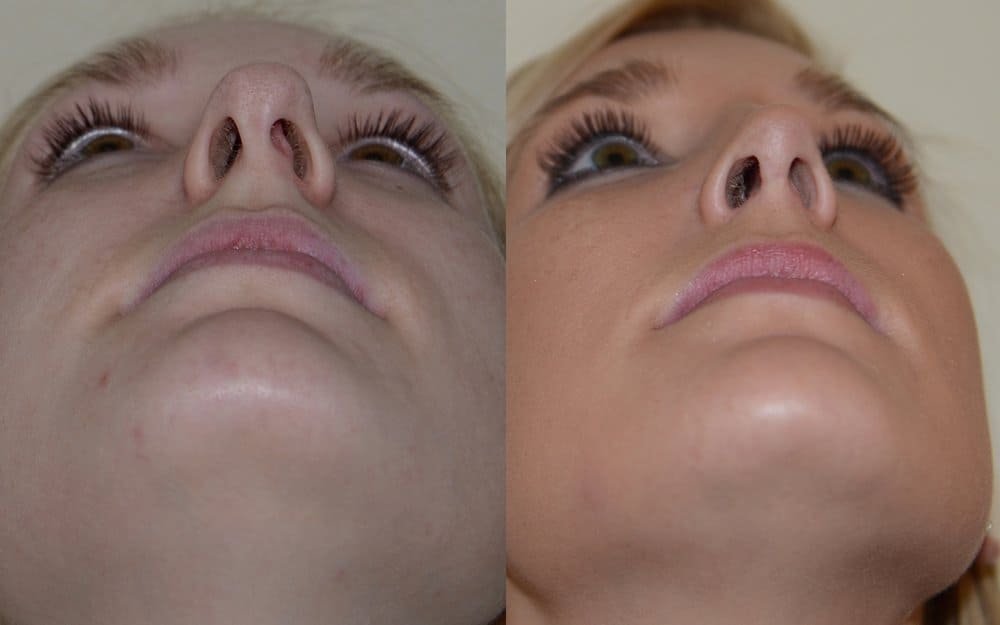 Open rhinoplasty with hump reduction and tip refinement