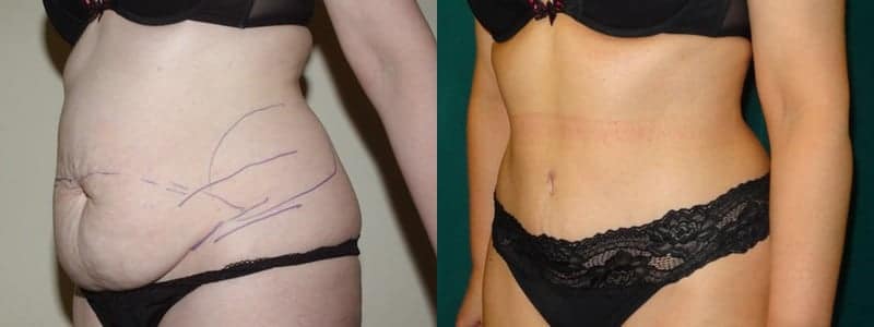 hypercor weight loss reviews Hypercor weight loss reviews