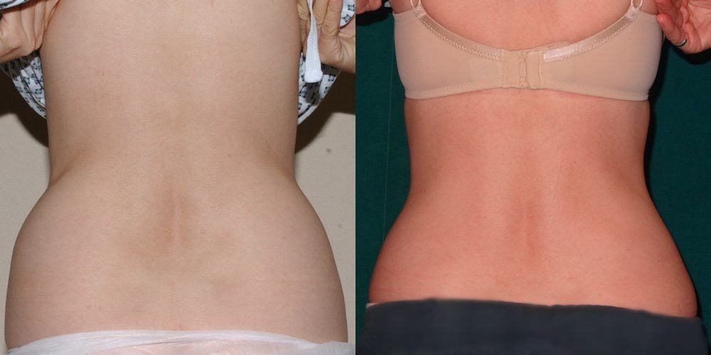 back liposuction glasgow