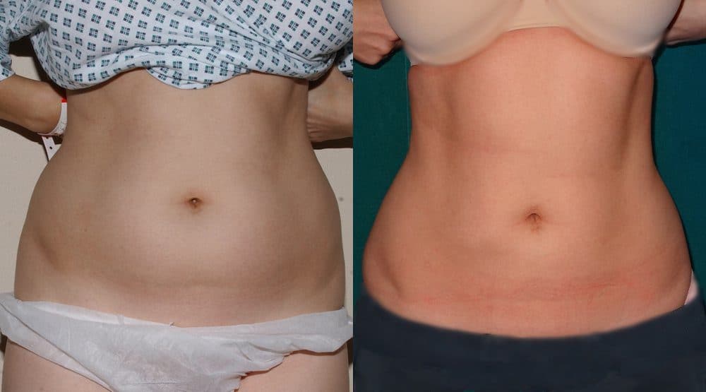 Liposuction Before and After Photos