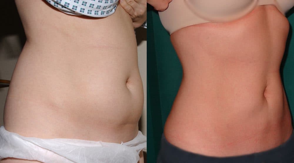 liposuction photos