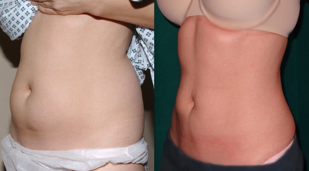 Liposuction Before and After Photos