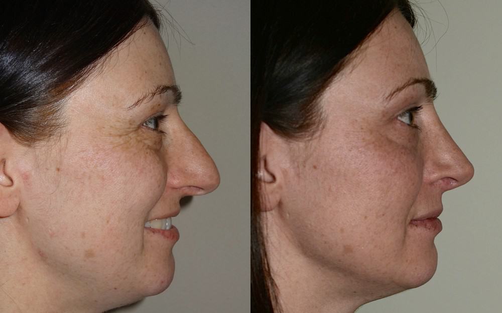 Open rhinoplasty with tip grafts