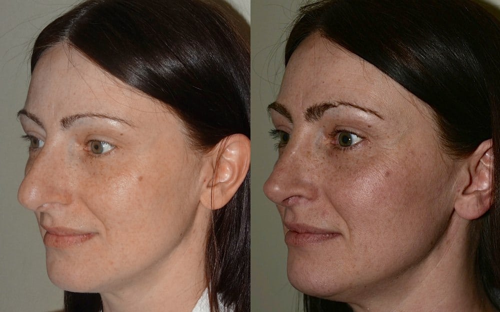 Open rhinoplasty with tip grafts