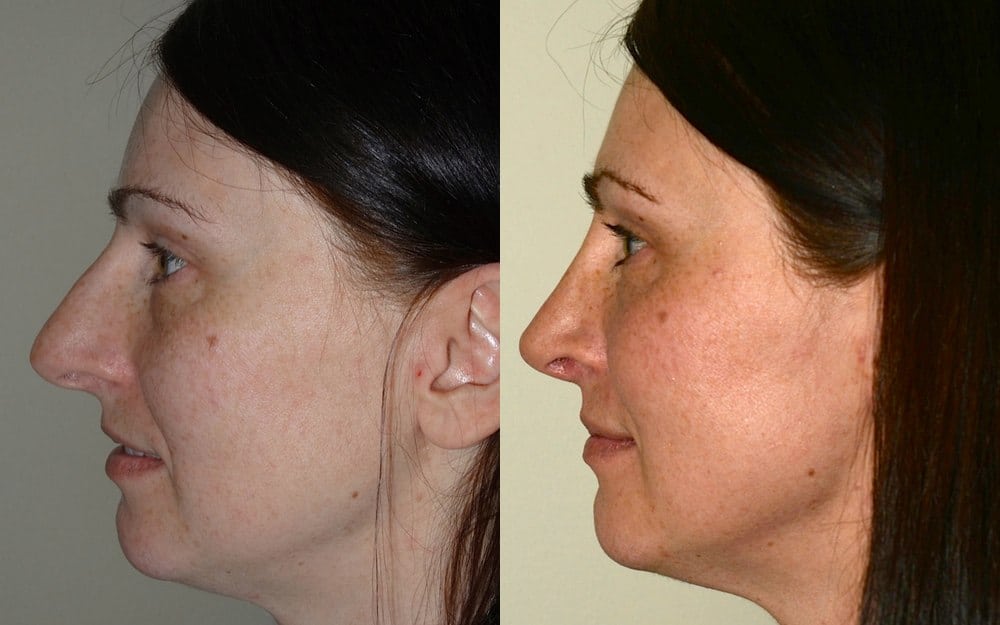 rhinoplasty scotland