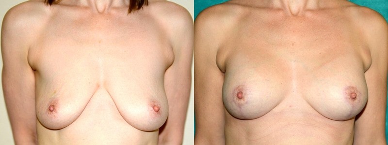 A breast lift combined with implants
