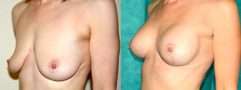 Breast lift combined with implants