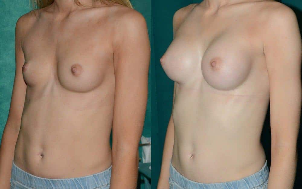 Minor breast asymmetry and correction of inverted nipple