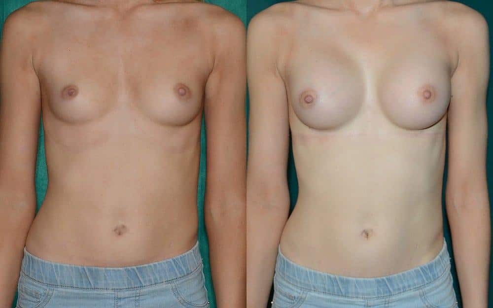 Minor breast asymmetry and correction of inverted nipple