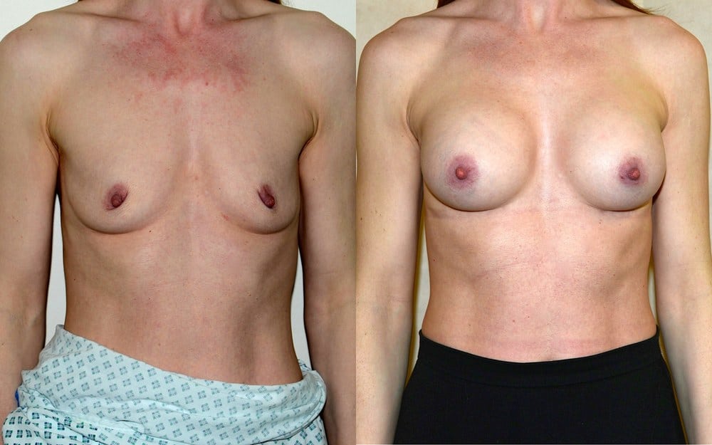 Breast augmentation