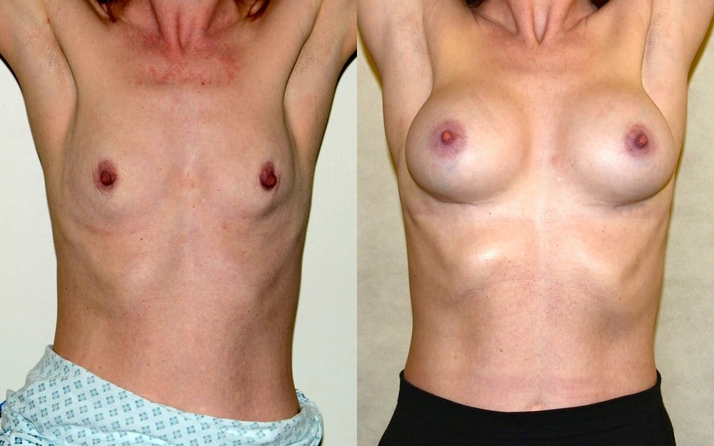 Breast augmentation