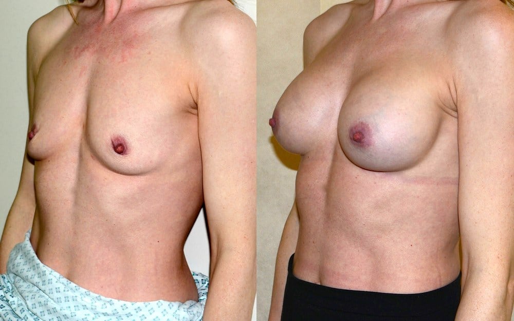 Breast augmentation