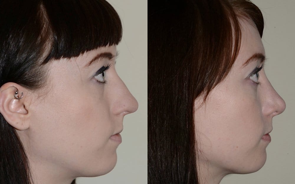 Hump reduction, narrowing of the nose and tip refinement