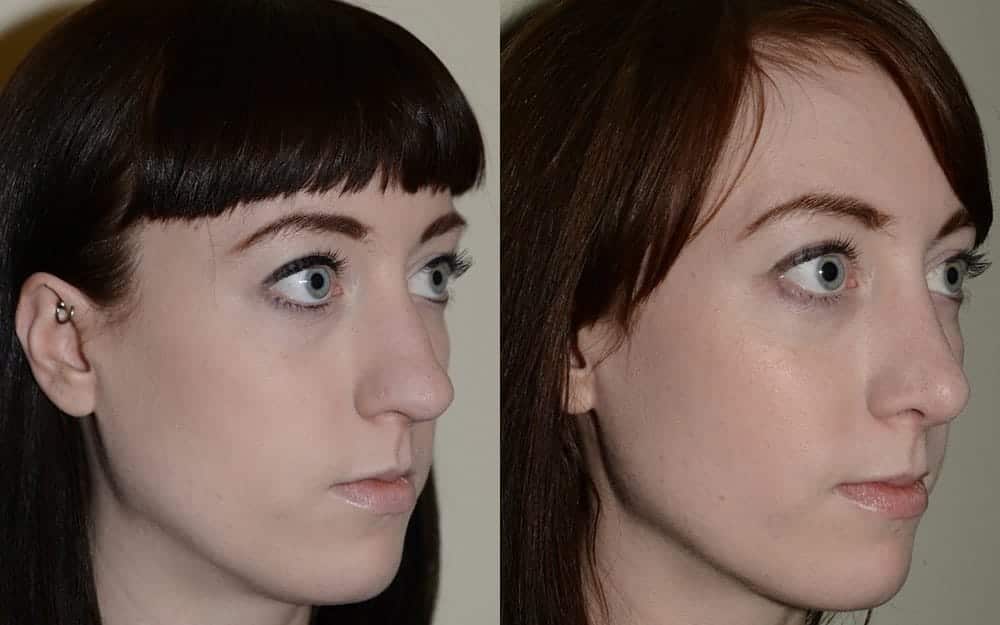 Hump reduction, narrowing of the nose and tip refinement