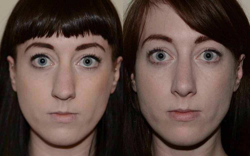 Hump reduction, narrowing of the nose and tip refinement