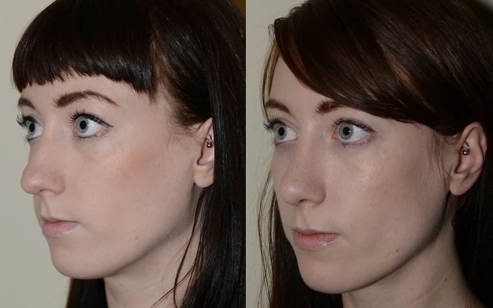 Hump reduction, narrowing of the nose and tip refinement