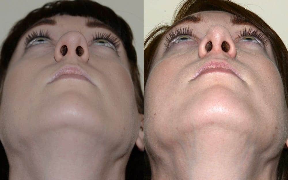 Hump reduction, narrowing of the nose and tip refinement