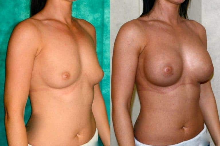 Breast implants before and after, case 36, photo 1 of 3