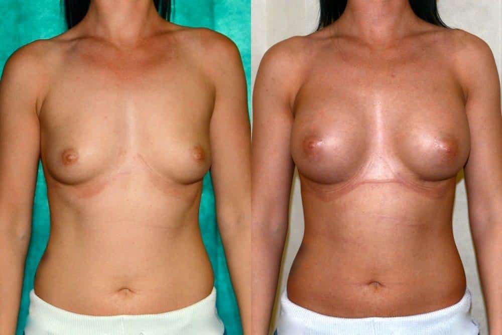 breast augmentation glasgow