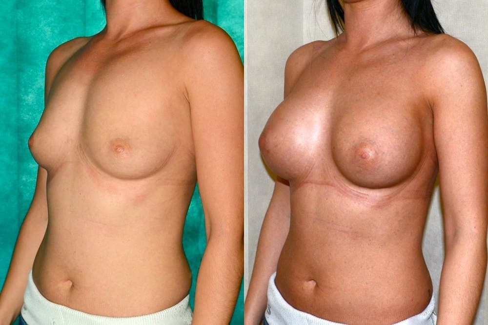 breast implants before and after uk