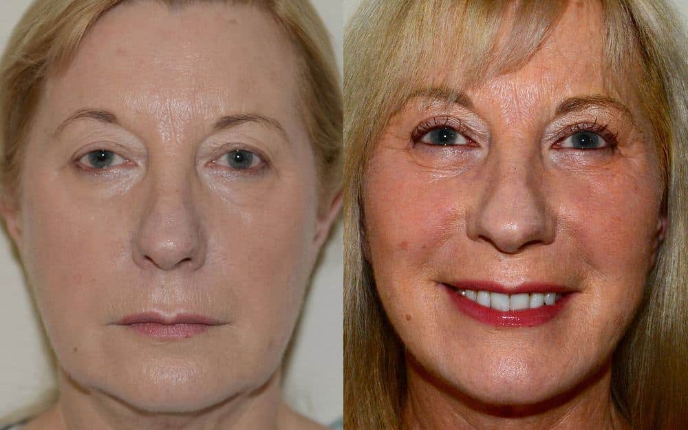 Lower neck/ facelift