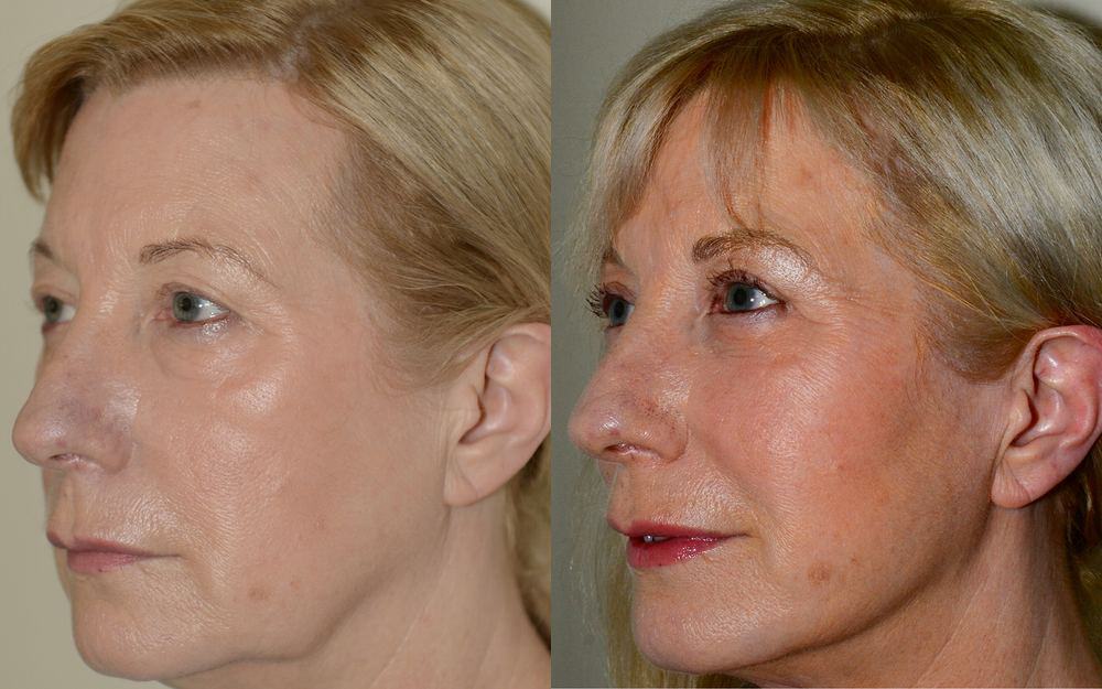 Lower neck/ facelift