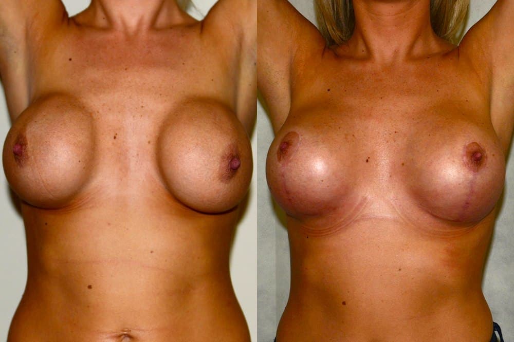 revision breast surgery scotland uk