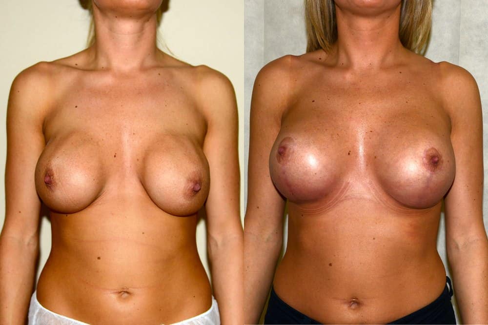 breast implant rippling - before and after