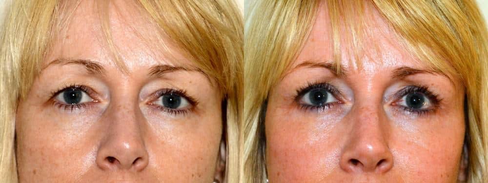 Upper and lower eyelid surgery 