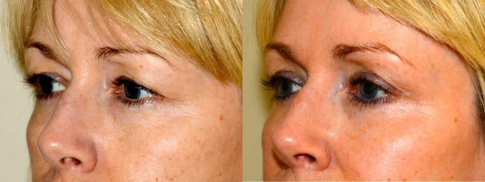 blepharoplasty before and after uk