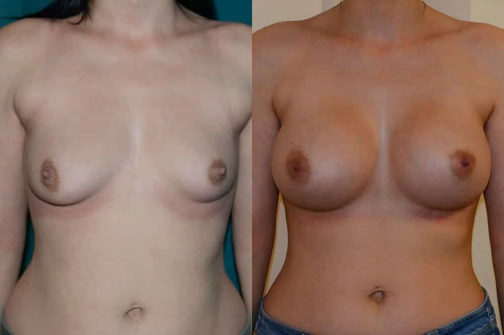Large volume implants in a patient with previous pregnancies