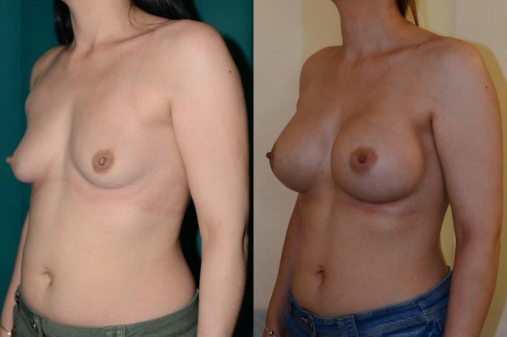 Large volume implants in a patient with previous pregnancies