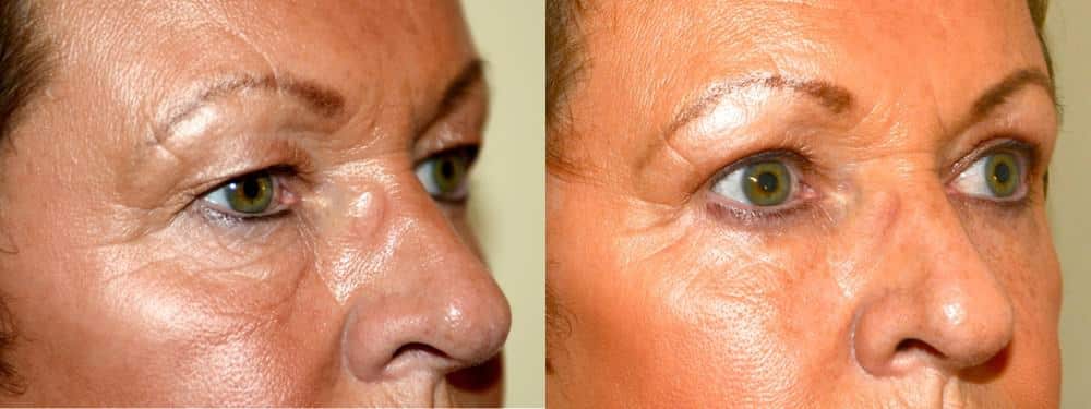 Upper and lower eyelid surgery