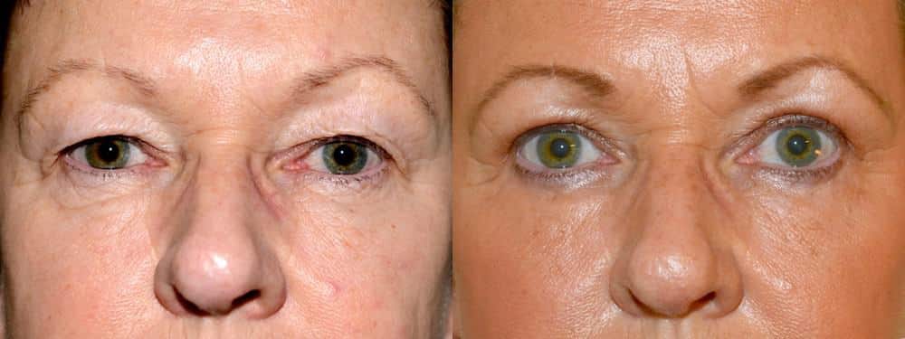 Upper and lower eyelid surgery