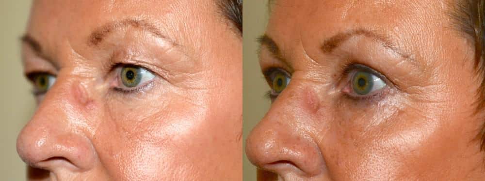 Upper and lower eyelid surgery