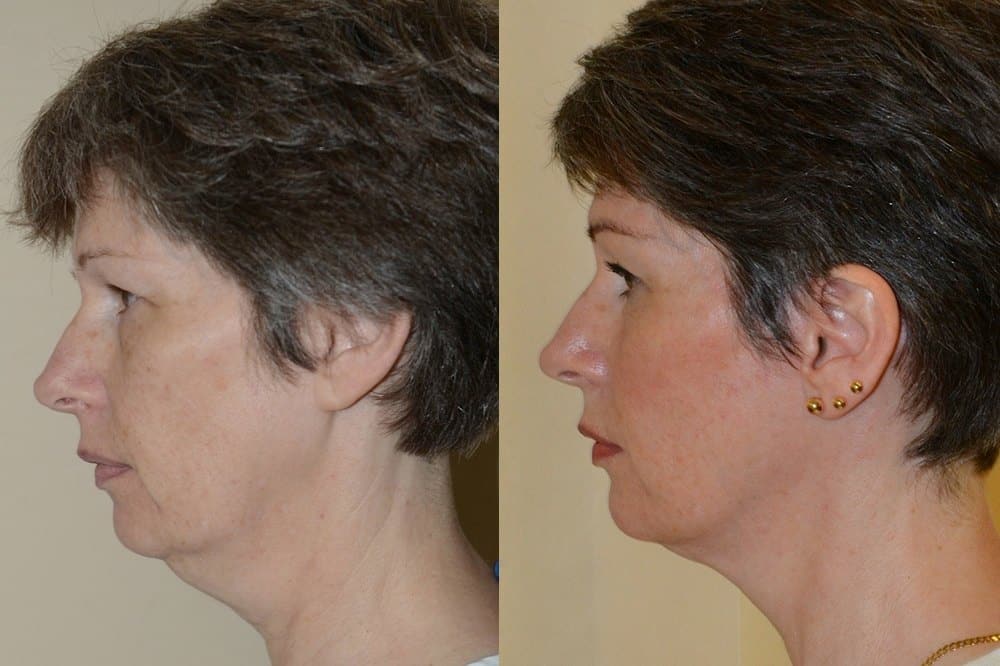 Facelift photos and neck liposuction