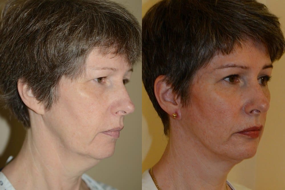 Facelift photos and neck liposuction